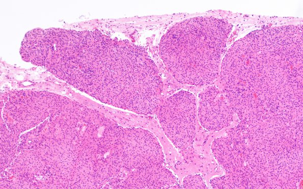 16A2 Meningioma, Grade II Brain invasion (Case 16) H&E 1