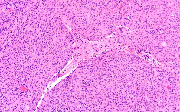 16A3 Meningioma, Grade II Brain invasion (Case 16) H&E 20X