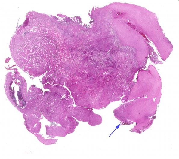 17A1 Meningioma, rhabdoid & brain invasion (Case 17) H&E WM