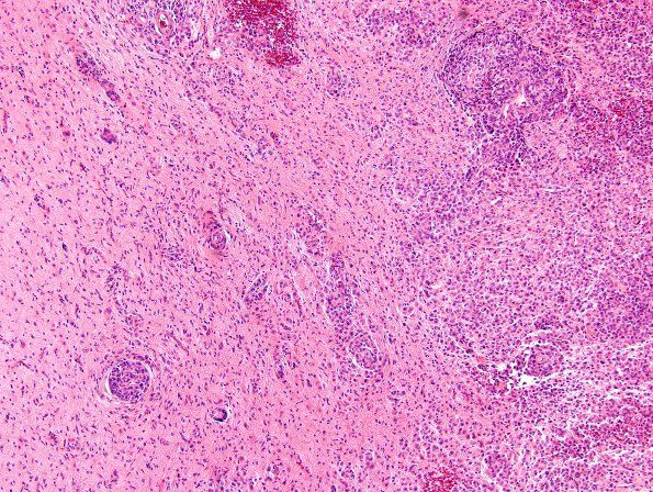 17A3 Meningioma, rhabdoid & brain invasion (Case 17) H&E 4.jpg