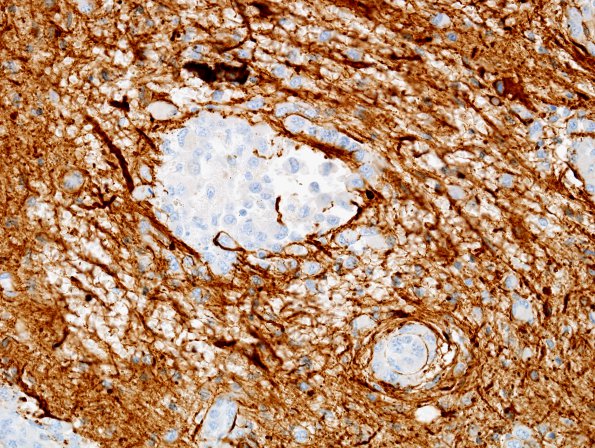 17B3 Meningioma, rhabdoid & brain invasion (Case 17) GFAP 1.jpg