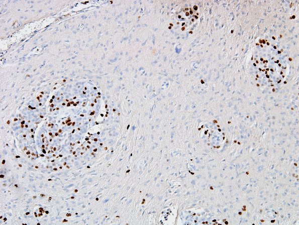 17C Meningioma, rhabdoid & brain invasion (Case 17) Ki67 2.jpg