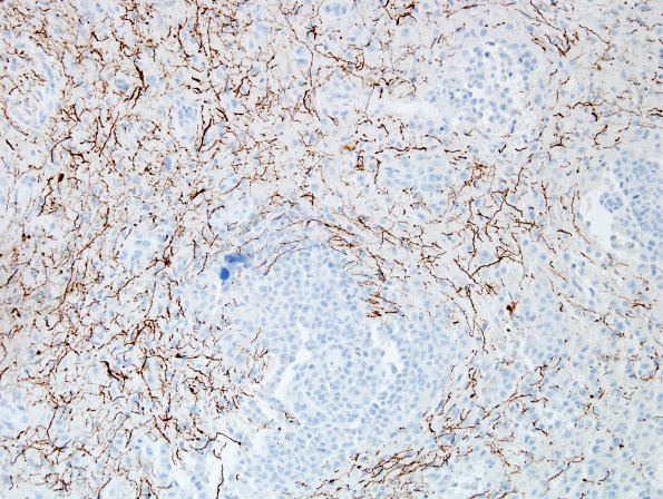 17D1 Meningioma, rhabdoid & brain invasion (Case 17) NF 3.jpg