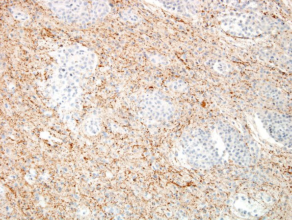 17D2 Meningioma, rhabdoid & brain invasion (Case 17) SYN 1.jpg