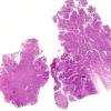 18A1 Meningioma, WHO II brain invasion (Case 18) H&E WM