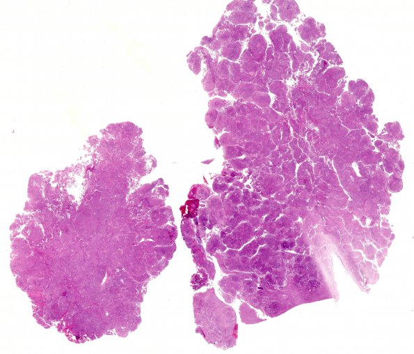 18A1 Meningioma, WHO II brain invasion (Case 18) H&E WM