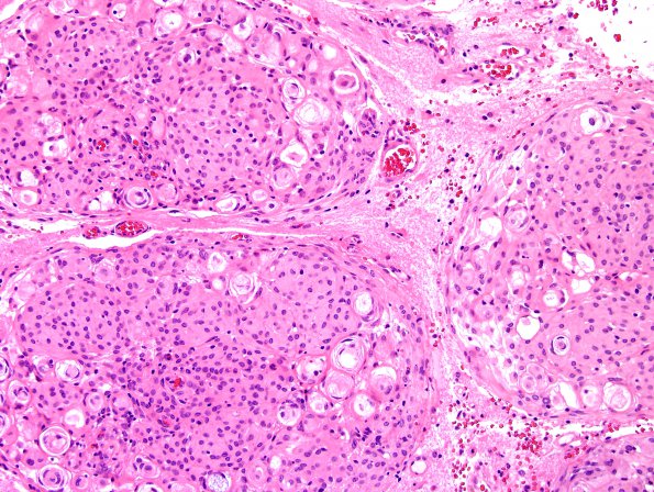 18A2 Meningioma, WHO II brain invasion (Case 18) H&E 3.jpg