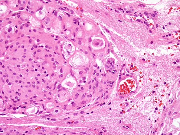 18A3 Meningioma, WHO II brain invasion (Case 18) H&E 4.jpg