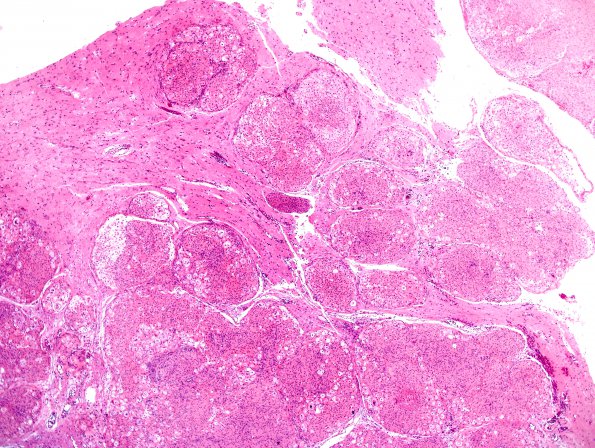 18A4 Meningioma, WHO II brain invasion (Case 18) H&E 8.jpg