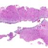 19A1 Meningioma WHO-II (Case 19) H&E WM