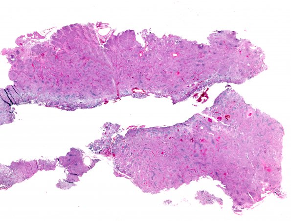 19A1 Meningioma WHO-II (Case 19) H&E WM