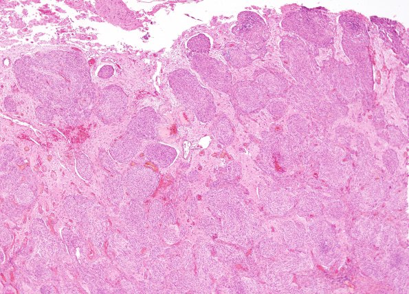 19A2 Meningioma (Case 19) H&E 4