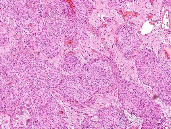 19A3 Meningioma (Case 19) H&E 2