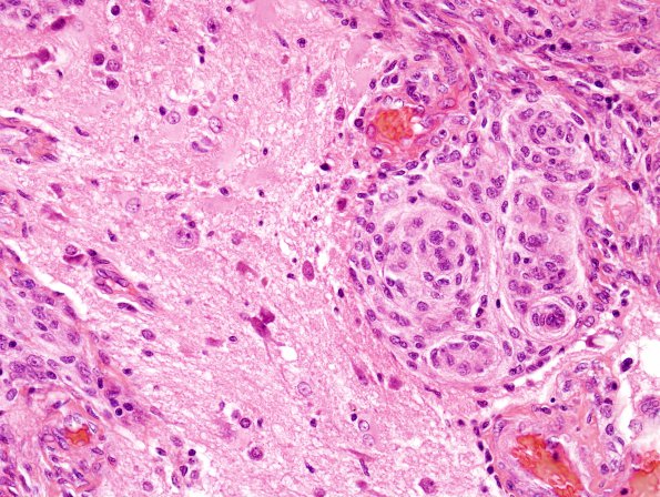 19A4 Meningioma (Case 19) H&E 1