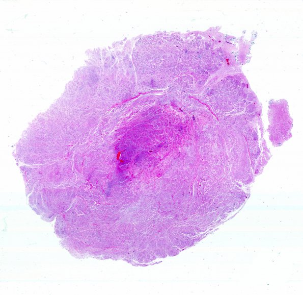 1A1 Meningioma, WHO II, brain invasion (Case 1) N17 H&E WM