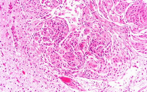 1A2 Meningioma, WHO II, brain invasion (Case 1) N 20X H&E