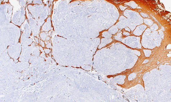 1B2 Meningioma, WHO II, brain invasion (Case 1) N 2X GFAP