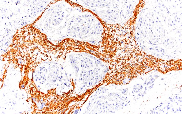 1B3 Meningioma, WHO II, brain invasion (Case 1) N 20X GFAP