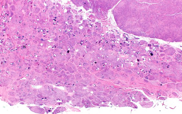 20A1 Meningioma, atypical (Case 20) H&E 2X