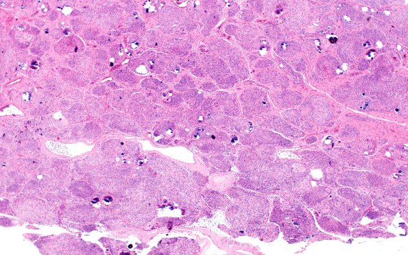 20A2 Meningioma, atypical (Case 20) H&E 4X