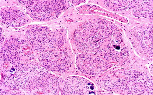 20A3 Meningioma, atypical (Case 20) H&E 20X