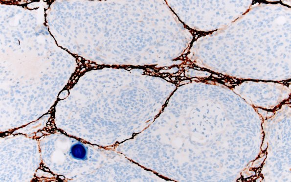 20B3 Meningioma, atypical (Case 20) GFAP 20X