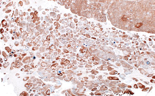 20C1 Meningioma, atypical (Case 20) EMA 2X