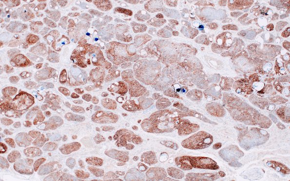 20C2 Meningioma, atypical (Case 20) EMA 4X