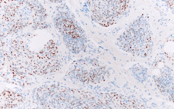 20D Meningioma, atypical (Case 20) PR 20X