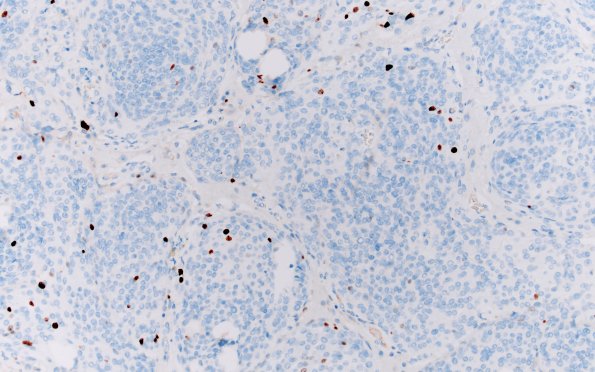 20E Meningioma, atypical (Case 20) Ki67 20X