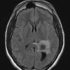 21A1 Meningioma, brain invasion (Case 21) FLAIR - Copy