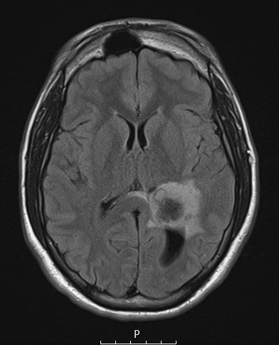 21A1 Meningioma, brain invasion (Case 21) FLAIR - Copy