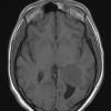 21A2 Meningioma, brain invasion (Case 21) T1 Axial no C - Copy