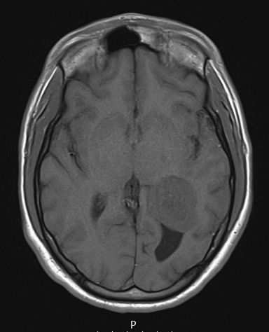 21A2 Meningioma, brain invasion (Case 21) T1 Axial no C - Copy