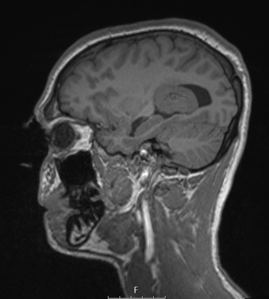 21A3 Meningioma, brain invasion (Case 21) T1 Sag - Copy