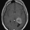 21A4 Meningioma, brain invasion (Case 21) T1W 21x - Copy