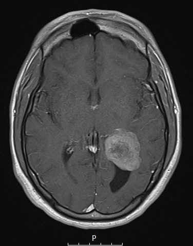 21A4 Meningioma, brain invasion (Case 21) T1W 21x - Copy