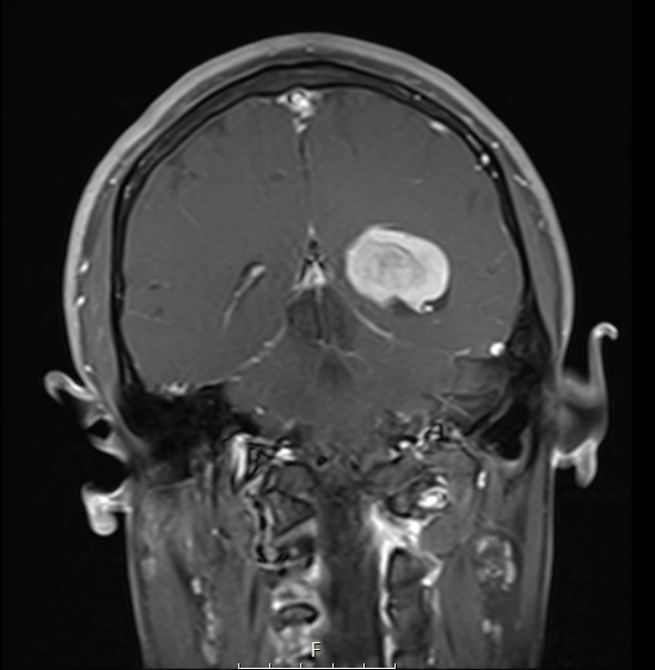 21A5 Meningioma, brain invasion (Case 21) T1W Cor - Copy