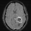 21A6 Meningioma, brain invasion (Case 21) SWI W - Copy