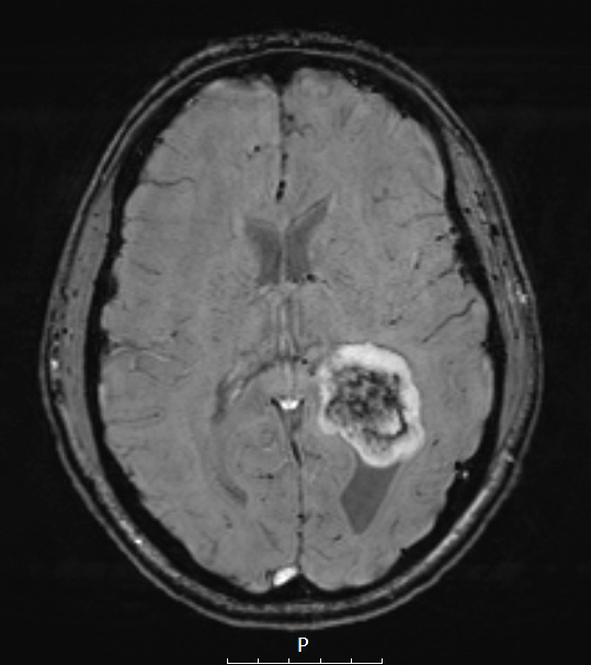 21A6 Meningioma, brain invasion (Case 21) SWI W - Copy