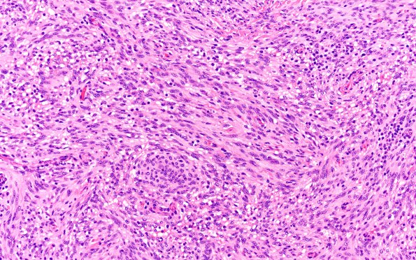 21B1 Meningioma, brain invasion (Case 21) H&E 20X 3