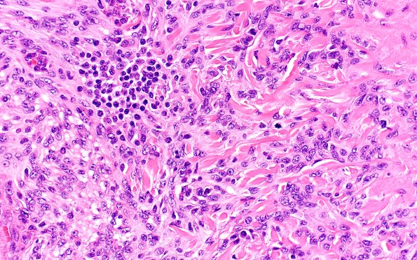 21B2 Meningioma, brain invasion (Case 21) H&E 40X 2