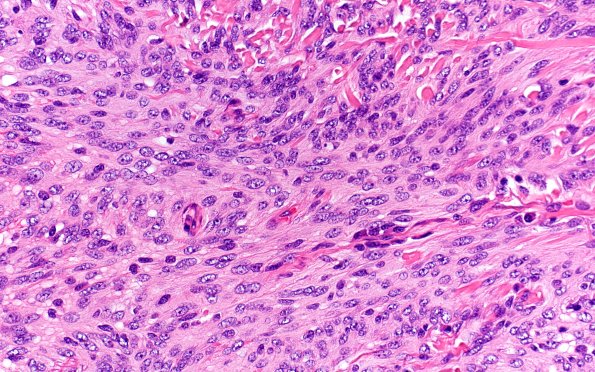 21B3 Meningioma, brain invasion (Case 21) H&E 40X