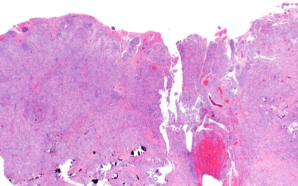 21B4 Meningioma, brain invasion (Case 21) H&E 2X