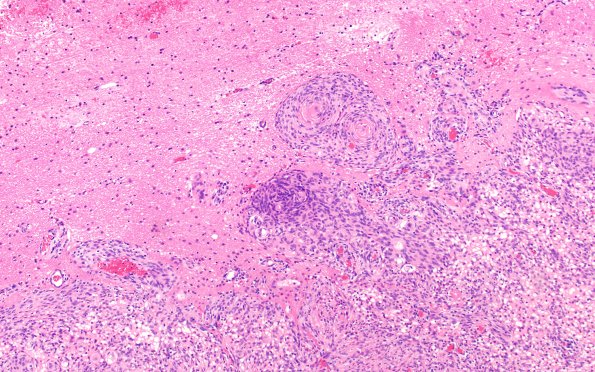 21B5 Meningioma, brain invasion (Case 21 H&E 10X