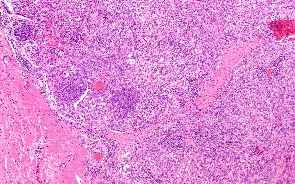 21B6 Meningioma, brain invasion (Case 21) H&E 10X 2