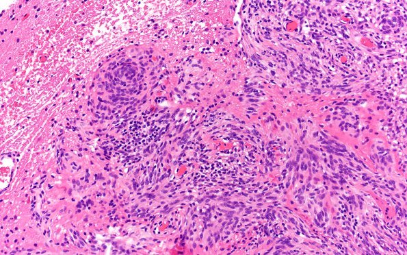 21B7 Meningioma, brain invasion (Case 21) H&E 20X 2