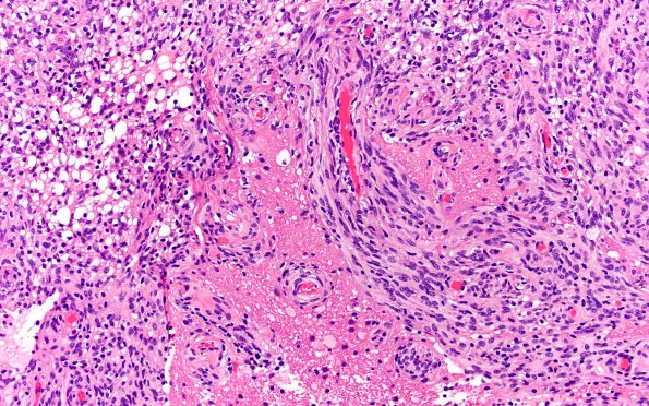 21B8 Meningioma, brain invasion (Case 21) H&E 20X