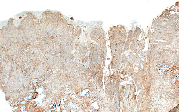 21C Meningioma, brain invasion (Case 21) EMA 2X