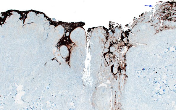 21D1 Meningioma, brain invasion (Case 21) GFAP 2X copy